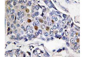 Immunohistochemical analysis of paraffin-embedded human breast cancer tissue using POLR3A polyclonal antibody . (POLR3A anticorps)