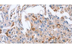 Immunohistochemistry of paraffin-embedded Human lung cancer tissue using NRG4 Polyclonal Antibody at dilution 1:60 (Neuregulin 4 anticorps)