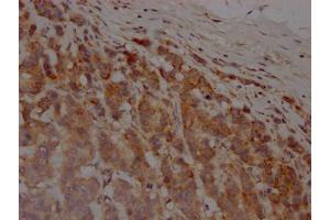 IHC image of ABIN7127624 diluted at 1:100 and staining in paraffin-embedded human breast cancer performed on a Leica BondTM system.
