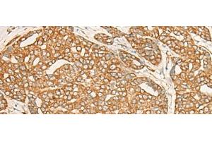 Immunohistochemistry of paraffin-embedded Human liver cancer tissue using DARS Polyclonal Antibody at dilution of 1:25(x200) (DARS anticorps)