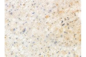 ABIN7096855 and ABIN7100921 at 1/100 staining human astrocytoma by IHC-P.
