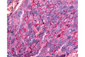 Anti-GALR2 / Galanin Receptor 2 antibody IHC of human Ovary, Carcinoma.