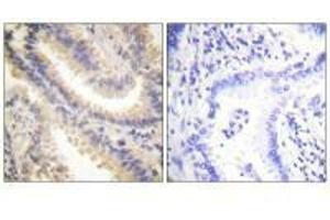 Immunohistochemistry analysis of paraffin-embedded human lung carcinoma tissue using TIMP4 antibody. (TIMP4 anticorps  (C-Term))