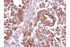 IHC-P Image CCR8 antibody detects CCR8 protein at cytosol and membrane on human hepatoma by immunohistochemical analysis. (CCR8 anticorps  (C-Term))