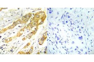 Immunohistochemical analysis of paraffin- embedded human breast carcinoma tissue using ERK1/2 (Thr202/Tyr204) antibody (E022017). (ERK1/2 anticorps)