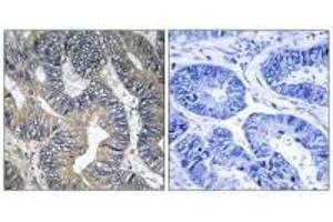 Immunohistochemistry analysis of paraffin-embedded human colon carcinoma tissue using GTPBP2 antibody. (GTPBP2 anticorps)