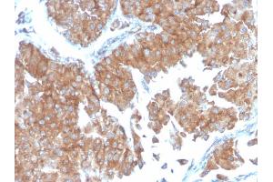 Formalin-fixed, paraffin-embedded human Urothelial Carcinoma stained with PAI-RBP1 Mouse Monoclonal Antibody (SERBP1/3498). (SERBP1 anticorps  (AA 3-139))
