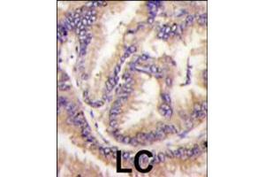Formalin-fixed and paraffin-embedded human lung carcinoma tissue reacted with STK9 Antibody , which was peroxidase-conjugated to the secondary antibody, followed by DAB staining.