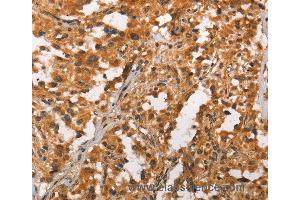 Immunohistochemistry of Human thyroid cancer using CRKL Polyclonal Antibody at dilution of 1:25