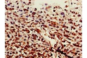 Immunohistochemistry of paraffin-embedded human melanoma using ABIN7143911 at dilution of 1:100