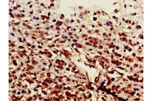 Immunohistochemistry of paraffin-embedded human melanoma using ABIN7143911 at dilution of 1:100 (ST6GALNAC1 anticorps  (AA 36-249))