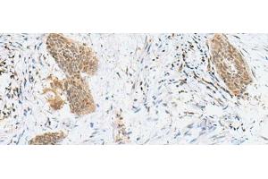 Immunohistochemistry of paraffin-embedded Human esophagus cancer tissue using LPXN Polyclonal Antibody at dilution of 1:60(x200) (Leupaxin anticorps)