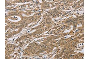 The image on the left is immunohistochemistry of paraffin-embedded Human gastric cancer tissue using ABIN7129118(CYFIP2 Antibody) at dilution 1/25, on the right is treated with fusion protein.