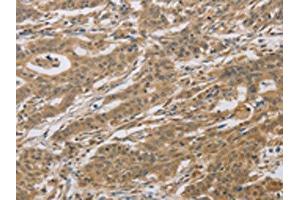 The image on the left is immunohistochemistry of paraffin-embedded Human gastric cancer tissue using ABIN7129118(CYFIP2 Antibody) at dilution 1/25, on the right is treated with fusion protein. (CYFIP2 anticorps)