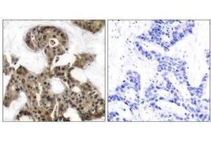 Immunohistochemical analysis of paraffin-embedded human breast carcinoma tissue using 4E-BP1 (Ab-45) antibody (E021216). (eIF4EBP1 anticorps)