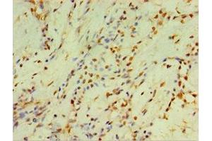 Immunohistochemistry of paraffin-embedded human breast cancer using ABIN7149253 at dilution of 1:100 (CYP2J2 anticorps  (AA 328-502))