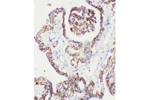Anti-Peroxiredoxin 5 antibody, IHC(P) IHC(P): Human Prostatic Cancer Tissue (Peroxiredoxin 5 anticorps  (C-Term))