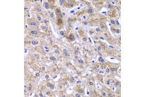 Immunohistochemistry of paraffin-embedded human liver injury using GOLM1 antibody at dilution of 1:100 (x40 lens). (GOLM1 anticorps)