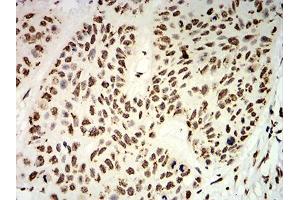 Immunohistochemical analysis of paraffin-embedded esophageal cancer tissues using UHRF1 mouse mAb with DAB staining.