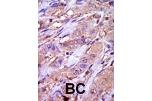 Formalin-fixed and paraffin-embedded human cancer tissue reacted with the primary antibody, which was peroxidase-conjugated to the secondary antibody, followed by DAB staining.