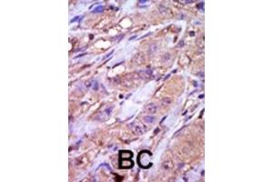 Formalin-fixed and paraffin-embedded human cancer tissue reacted with the primary antibody, which was peroxidase-conjugated to the secondary antibody, followed by DAB staining. (CK1 epsilon anticorps  (C-Term))