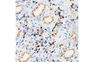 Immunohistochemistry of paraffin-embedded human thyroid cancer using eIF2A Rabbit mAb (ABIN7267035) at dilution of 1:100 (40x lens).