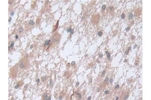 Detection of D2HGDH in Human Glioma Tissue using Polyclonal Antibody to D2-Hydroxyglutarate Dehydrogenase (D2HGDH)