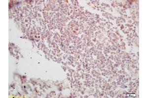 Formalin-fixed and paraffin embedded human lung carcinoma labeled with Rabbit Anti Histone H3-like protein Polyclonal Antibody, Unconjugated (ABIN670986) at 1:200 followed by conjugation to the secondary antibody and DAB staining (Centromeric Histone H3-Like Protein-2 (AA 51-145) anticorps)