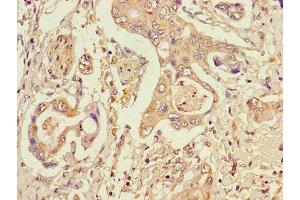 Immunohistochemistry of paraffin-embedded human pancreatic cancer using ABIN7150603 at dilution of 1:100