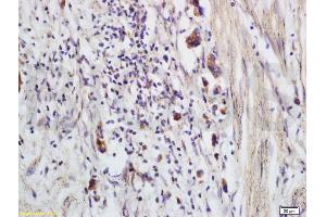 Formalin-fixed and paraffin embedded human colon carcinoma labeled with Anti-CCP Polyclonal Antibody, Unconjugated (ABIN736971) at 1:200 followed by conjugation to the secondary antibody and DAB staining (CRYGD anticorps)