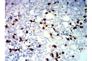 Immunohistochemical analysis of paraffin-embedded cervical cancer tissues using TNFRSF25 mouse mAb with DAB staining.
