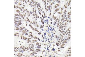 Immunohistochemistry of paraffin-embedded human colon carcinoma using Rad21 Rabbit pAb (ABIN7269822) at dilution of 1:200 (40x lens). (RAD21 anticorps)