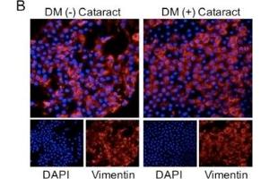 Cataracts induced epithelial-mesenchymal transition (EMT) progression with significantly elevated N-cadherin and MMP9 expression in DM (+) patients. (Vimentin anticorps)