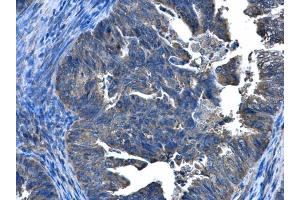 IHC-P Image CCDC83 antibody [N1C2] detects CCDC83 protein at cytoplasm and nucleus in human endometrial cancer by immunohistochemical analysis.