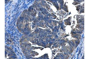 IHC-P Image CCDC83 antibody [N1C2] detects CCDC83 protein at cytoplasm and nucleus in human endometrial cancer by immunohistochemical analysis. (CCDC83 anticorps)