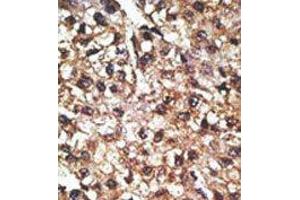 Formalin-fixed and paraffin-embedded human cancer tissue reacted with the primary antibody, which was peroxidase-conjugated to the secondary antibody, followed by AEC staining. (PINK1 anticorps  (N-Term))