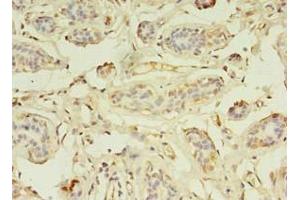 Immunohistochemistry of paraffin-embedded human breast cancer using ABIN7176199 at dilution of 1:100 (ZNF266 anticorps  (AA 257-549))