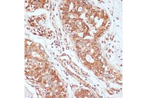 Immunohistochemistry of paraffin-embedded human mammary cancer using PTPRN2 antibody (ABIN7269710) at dilution of 1:100 (40x lens). (PTPRN2 anticorps  (AA 22-242))