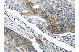 The image on the left is immunohistochemistry of paraffin-embedded Human esophagus cancer tissue using ABIN7131406(TMPRSS5 Antibody) at dilution 1/25, on the right is treated with fusion protein. (TMPRSS5 anticorps)