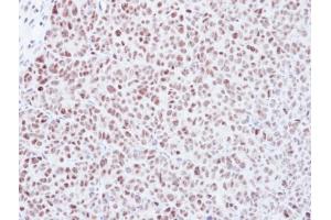 IHC-P Image Immunohistochemical analysis of paraffin-embedded DLD-1 xenograft, using Mad2L1, antibody at 1:500 dilution. (MAD2L1 anticorps  (C-Term))