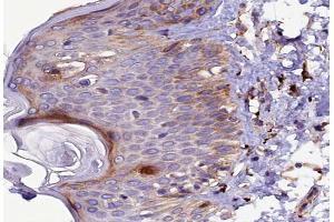 ABIN6267491 at 1/100 staining human Skin cancer tissue sections by IHC-P. (VEGFR2/CD309 anticorps  (pTyr1214))