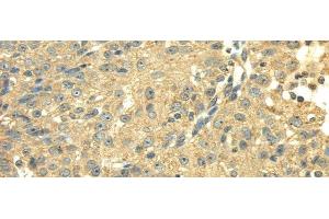 Immunohistochemistry of paraffin-embedded Human breast cancer using SDHA Polyclonal Antibody at dilution of 1/40