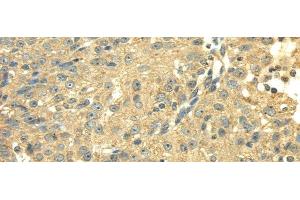 Immunohistochemistry of paraffin-embedded Human breast cancer using SDHA Polyclonal Antibody at dilution of 1/40 (SDHA anticorps)