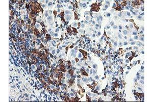 Immunohistochemical staining of paraffin-embedded Carcinoma of Human lung tissue using anti-GBP1 mouse monoclonal antibody. (GBP1 anticorps)