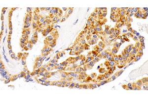 Detection of LAMP1 in Human Thyroid cancer Tissue using Polyclonal Antibody to Lysosomal Associated Membrane Protein 1 (LAMP1)