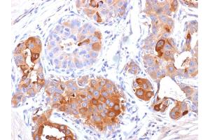 Formalin-fixed, paraffin-embedded human Breast Carcinoma stained with GCDFP-15 Mouse Monoclonal Antibody (PIP/1571). (PIP anticorps  (AA 41-146))