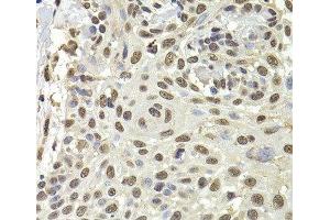 Immunohistochemistry of paraffin-embedded Human well-differentiated squamous skin carcinoma using PUF60 Polyclonal Antibody at dilution of 1:100 (40x lens). (PUF60 anticorps)
