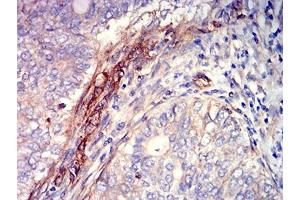 Immunohistochemical analysis of paraffin-embedded cervical cancer tissues using CD363 mouse mAb with DAB staining.