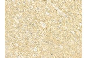ABIN6262899 and ABIN6273003 at 1/100 staining human glioblastoma by IHC-P. (L2HGDH anticorps  (Internal Region))