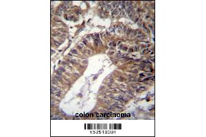 GCC1 Antibody immunohistochemistry analysis in formalin fixed and paraffin embedded human colon carcinoma followed by peroxidase conjugation of the secondary antibody and DAB staining.